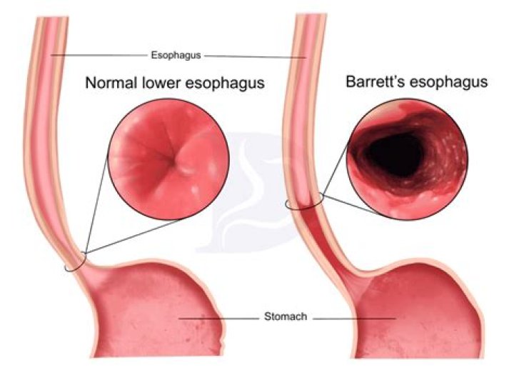 Can a collapsed esophagus be repaired?