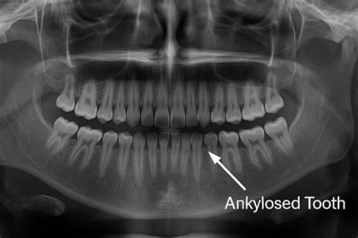 Can Ankylosed teeth be moved Orthodontically?