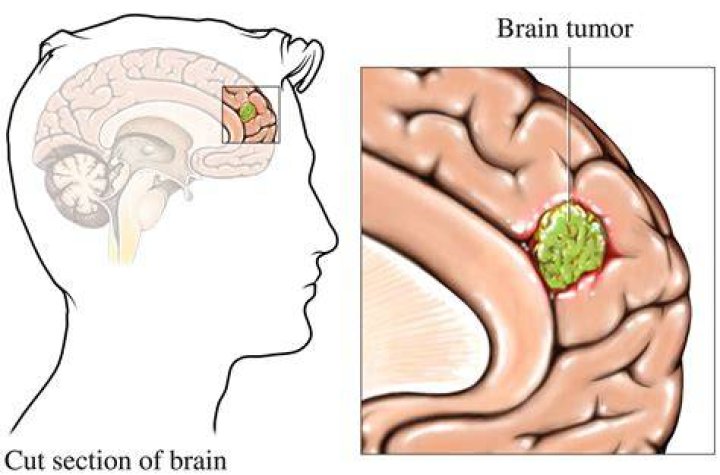 Can brain tumors be caused by environment?