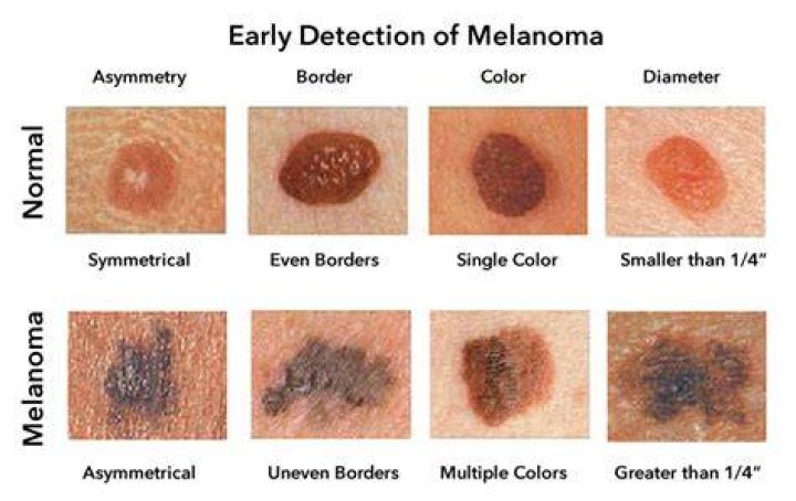 Can melanoma have no pigment?