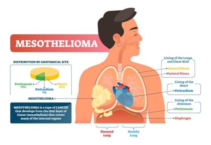Can mesothelioma be in the stomach?