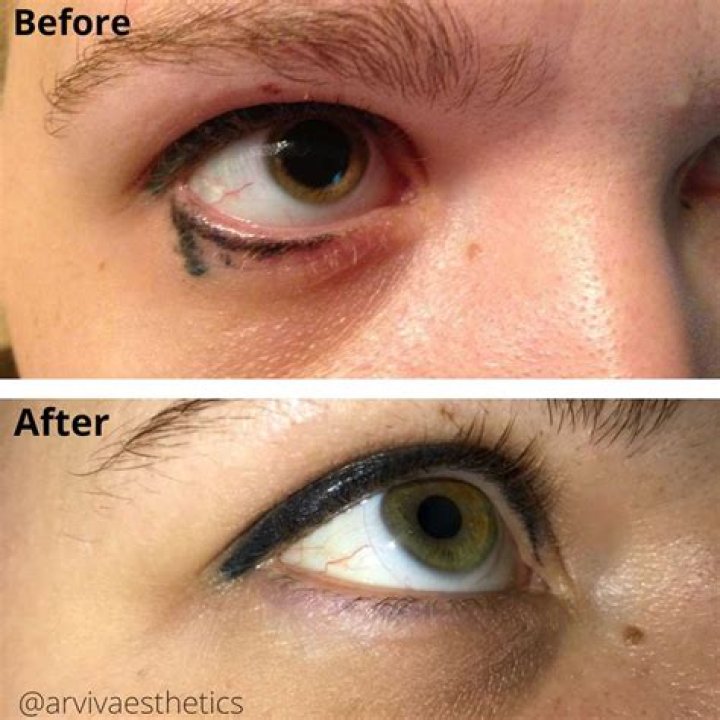 Can permanent makeup be removed?