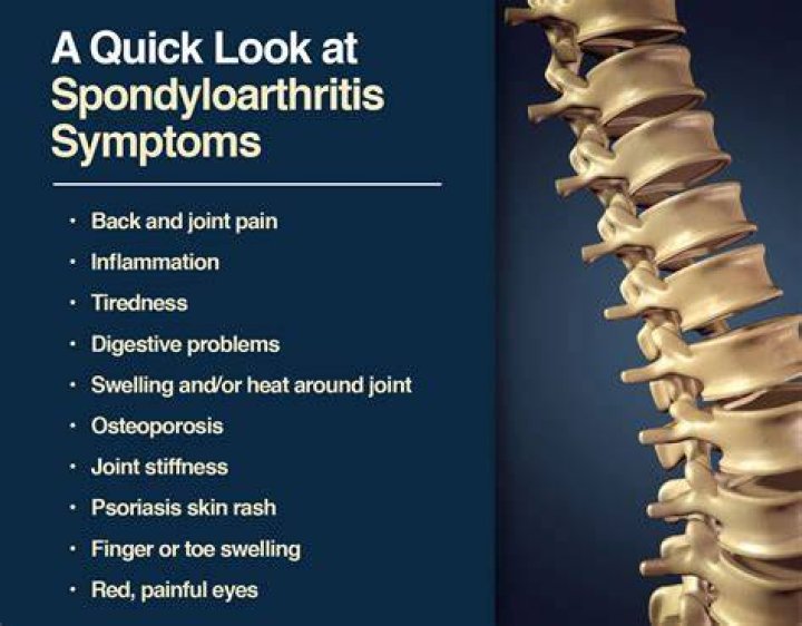 Can spondyloarthritis affect pregnancy?