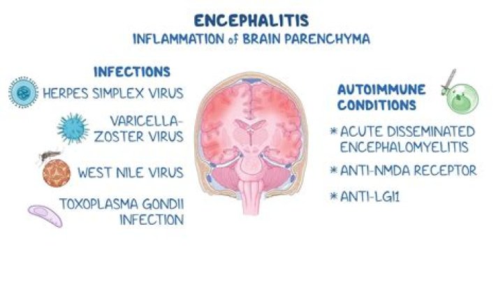 Can vasculitis cause encephalitis?