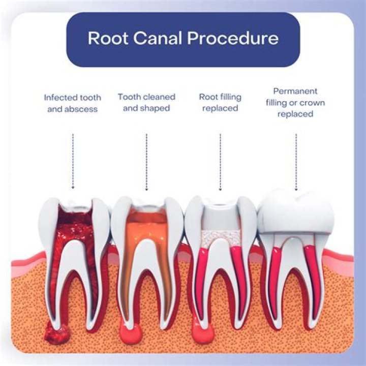 Can you do root canal on incisor?