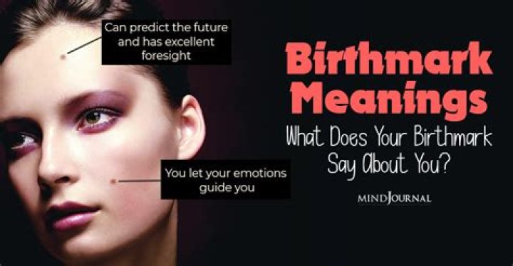 Can you erase a birthmark?
