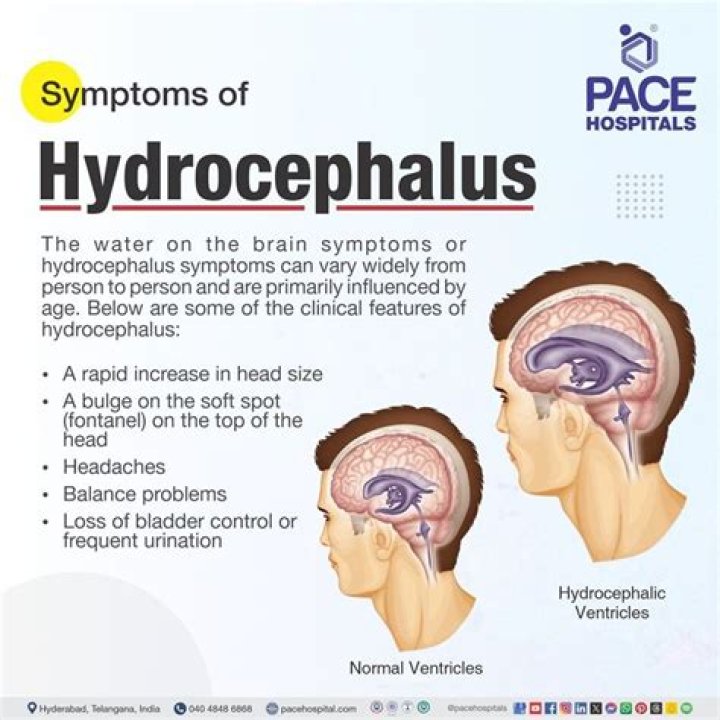 Does external hydrocephalus go away?