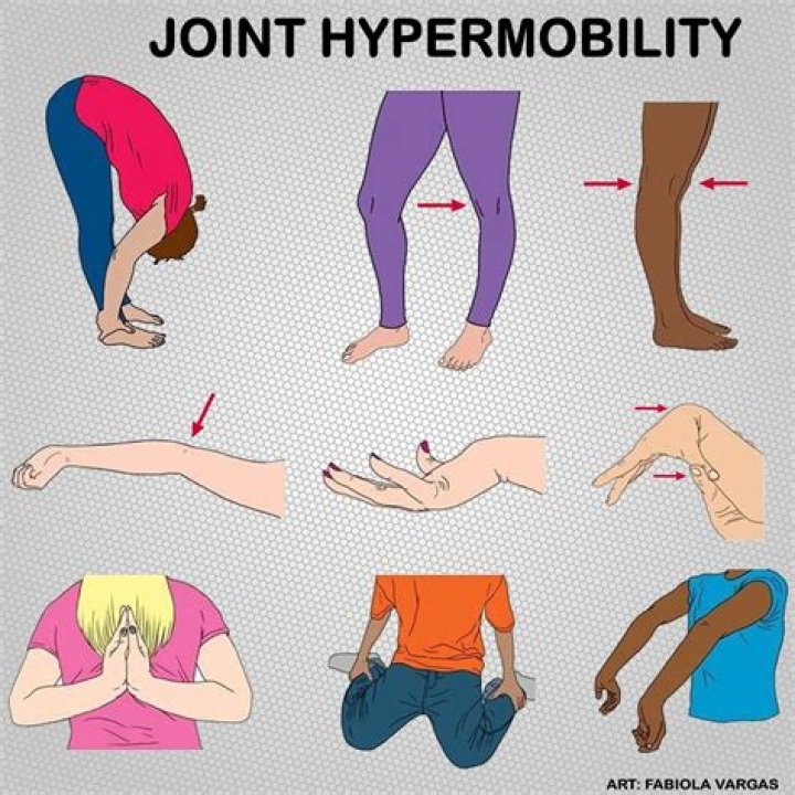 How do I know if my child has hypermobility?