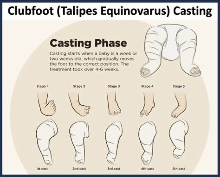 How do you evaluate clubfoot?