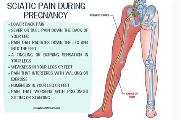 How do you fix sciatica when pregnant?