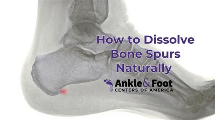 How do you get rid of a bone spur on the top of your foot?