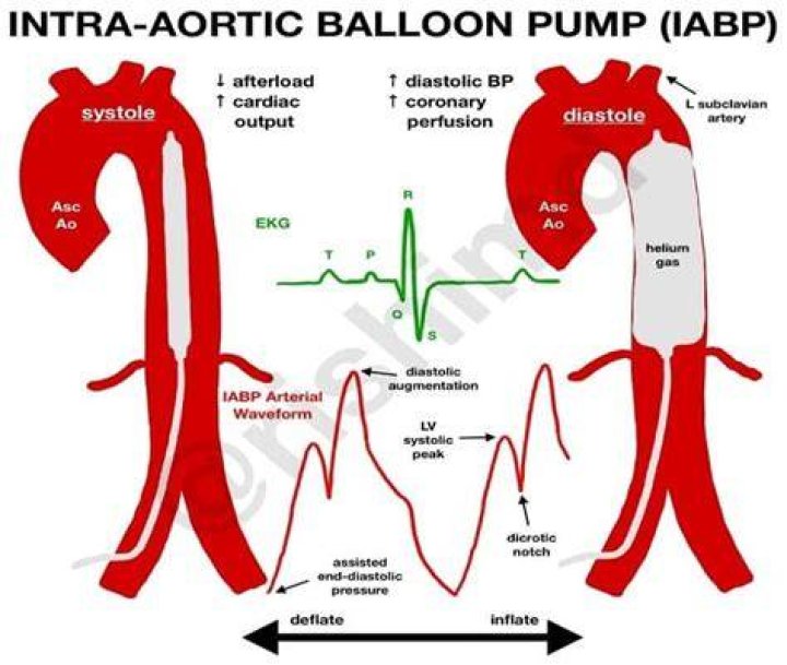How does the intra aortic balloon pump work?