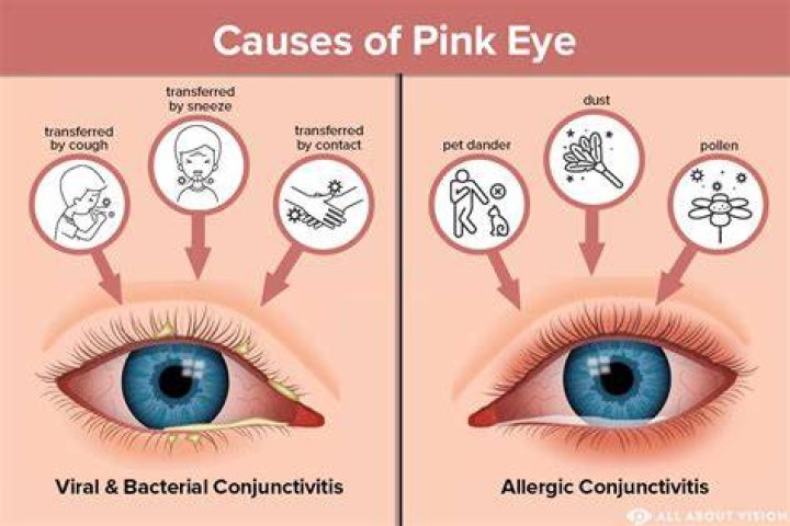 How Fast does pink eye go away?