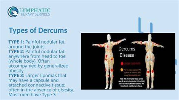 How is Dercums disease treated?