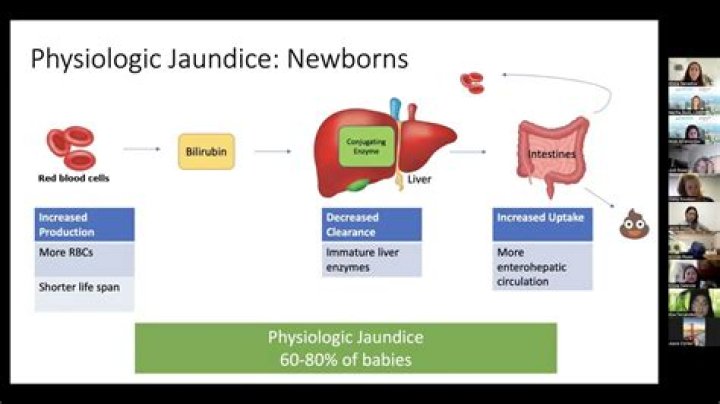 How is physiological jaundice diagnosed?