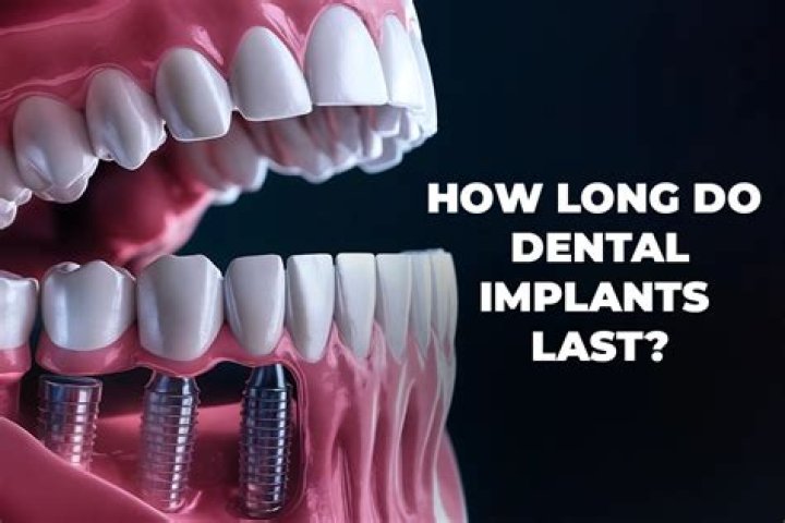 How long do forehead implants last?