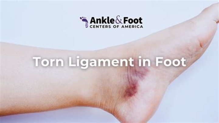 How long does a medial ligament take to heal?