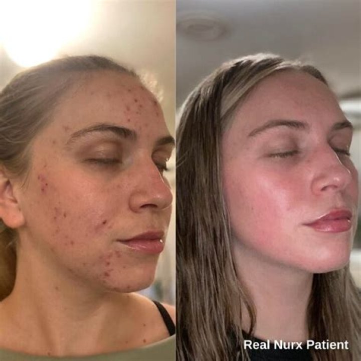 How long does it take for Stieva-a cream to work?