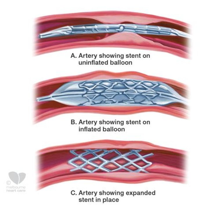 How long does it take to recover from a heart stent?