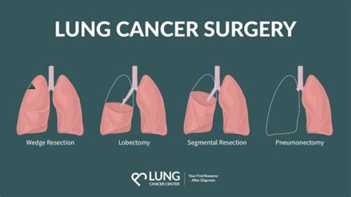 How much does a pneumonectomy cost?