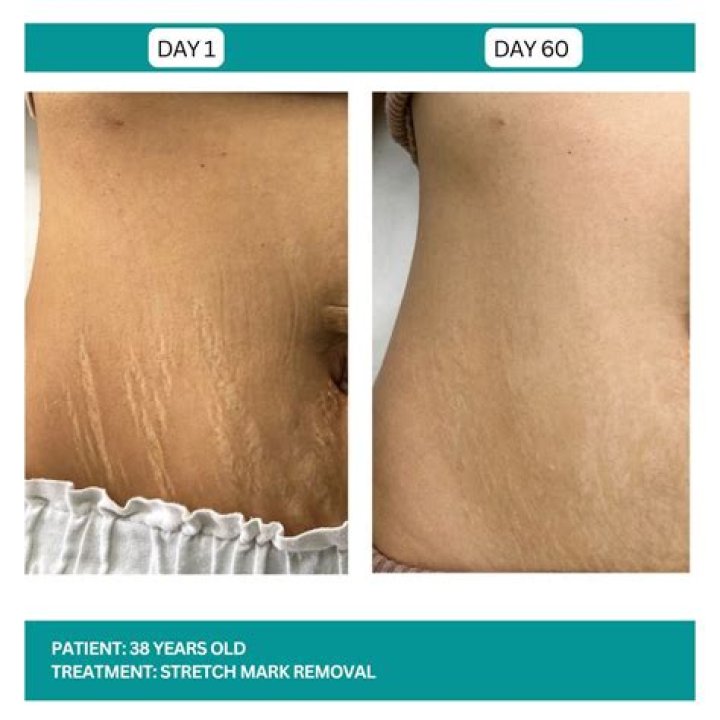 How much does stretch mark removal cost?