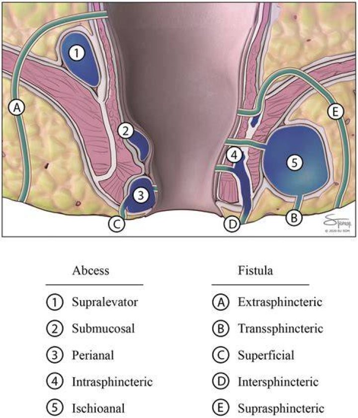 How serious is perianal fistula?
