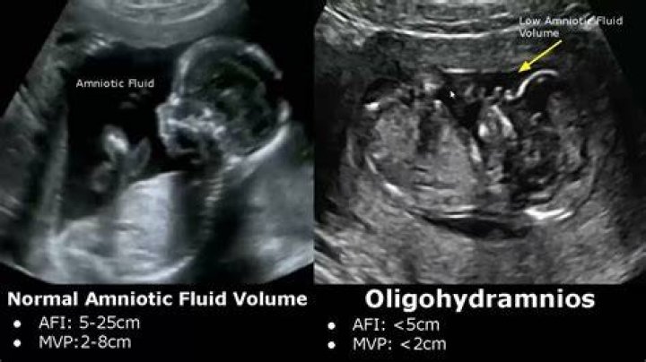 Is oligohydramnios genetic?
