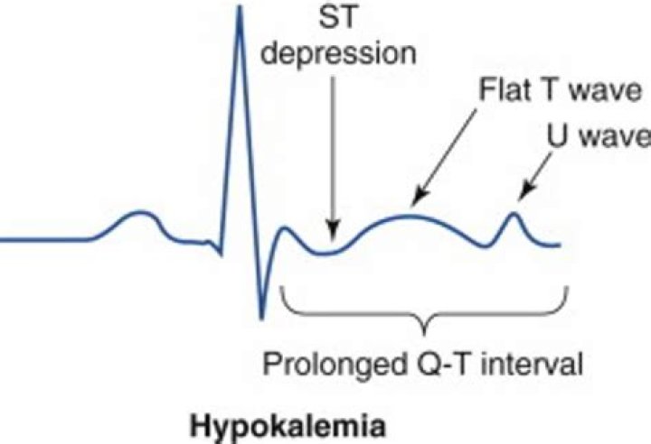 What are the ECG changes in hypokalemia?