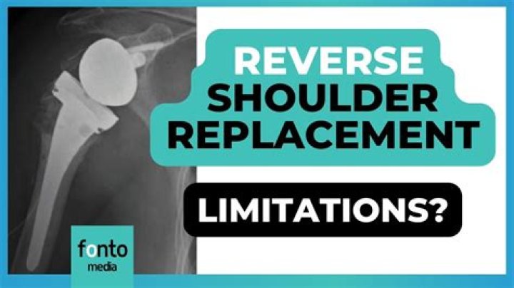 What are the limitations after reverse shoulder replacement?