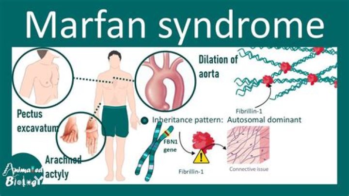 What athletes have Marfan syndrome?