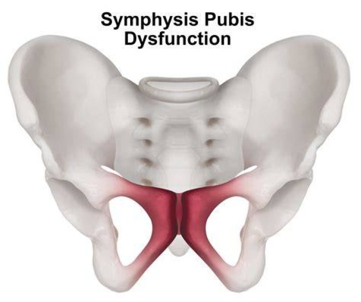 What can be done for symphysis pubis dysfunction?