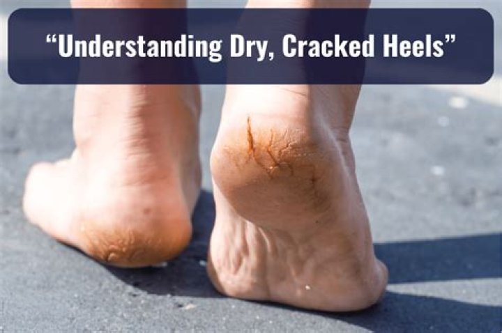 What causes dry cracked bottom of feet?