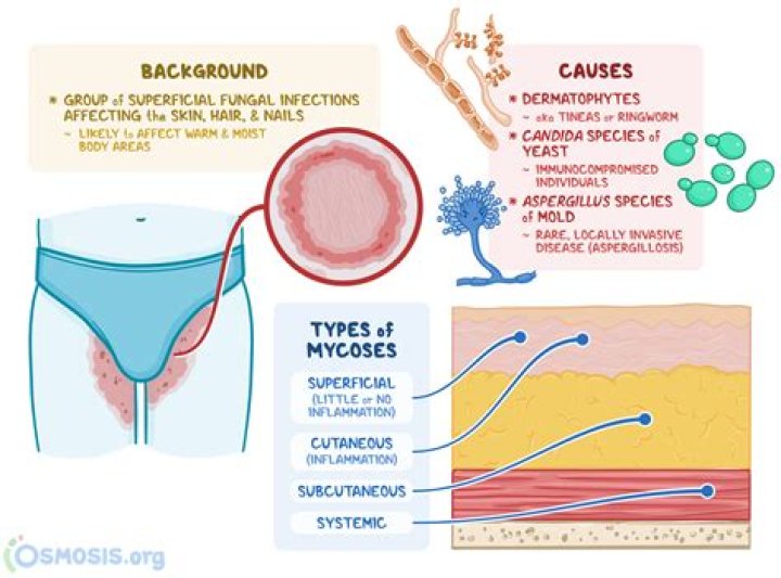 What causes IV site infections?