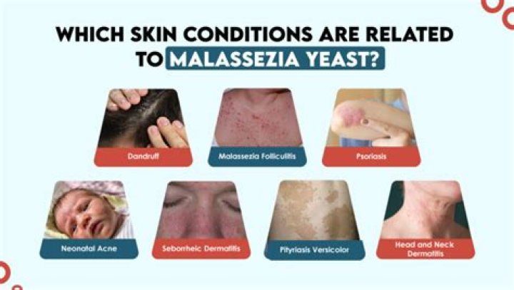 What causes Malassezia pachydermatis?