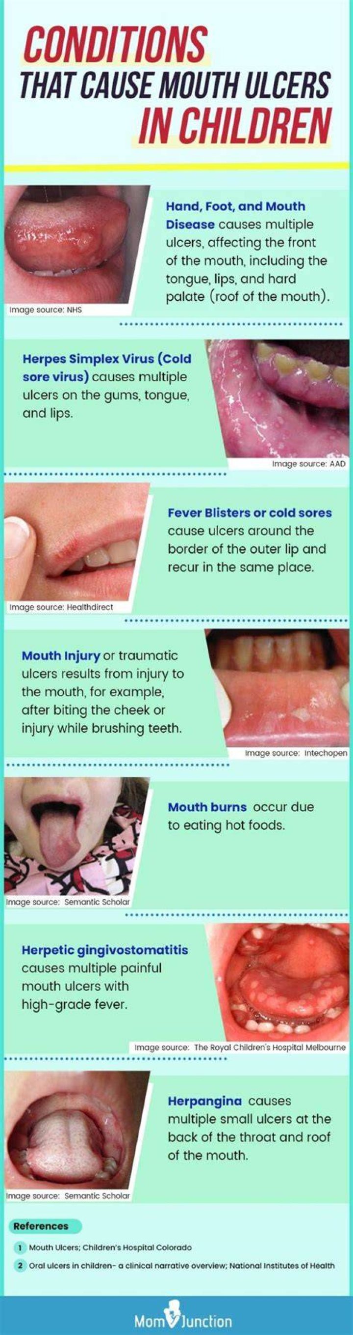 What causes mouth ulcers in a child?