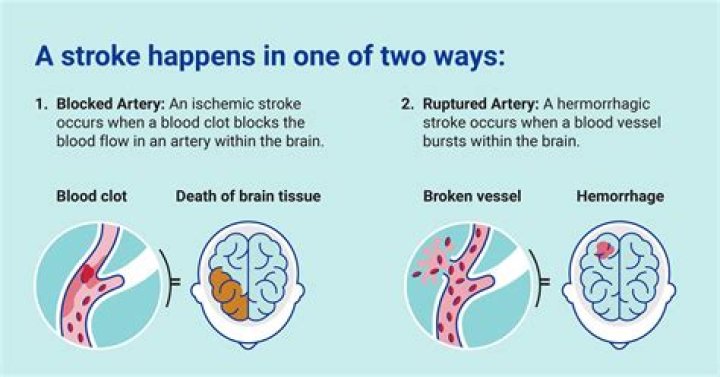 What causes stroke relapse?