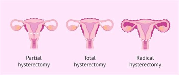 What does total vaginal hysterectomy mean?