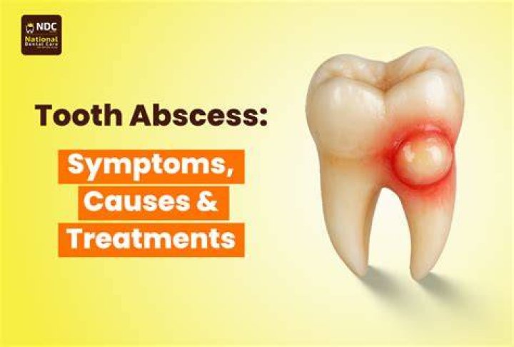 What happens if an abscess tooth pops in your mouth?