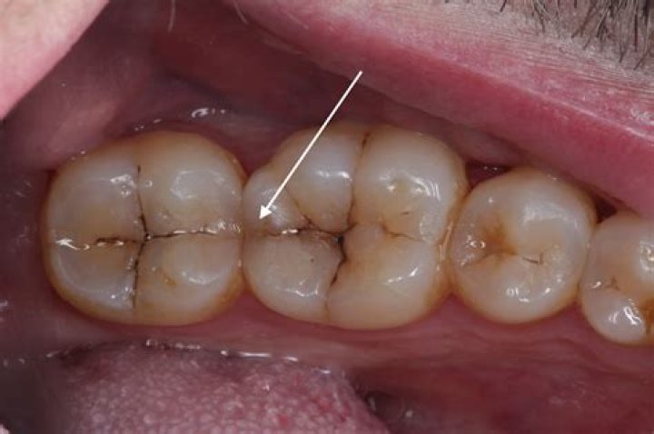 What happens if my molar is chipped?
