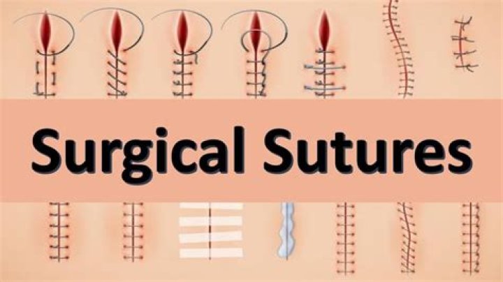 What is a caslick suture?