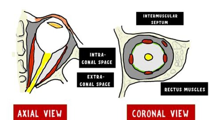 What is an intra-axial mass?