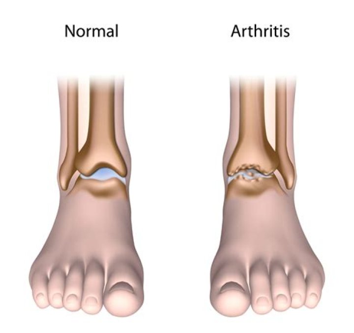 What is arthrosis of the ankle?