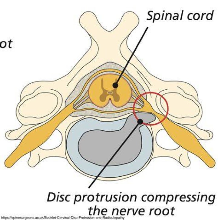 What is cervical disc protrusion?