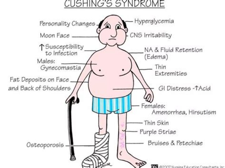 What is Cushing syndrome nursing?