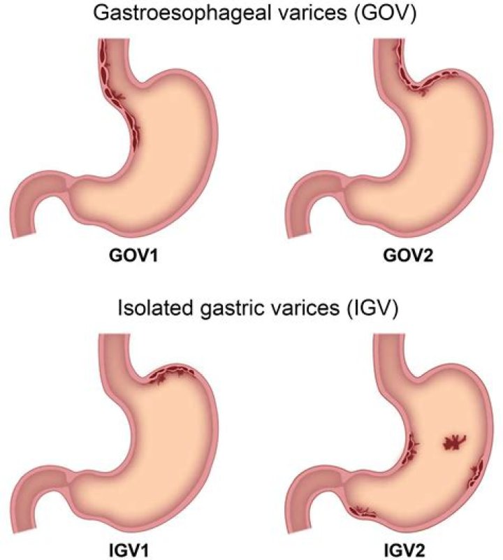 What is gastric Varix?