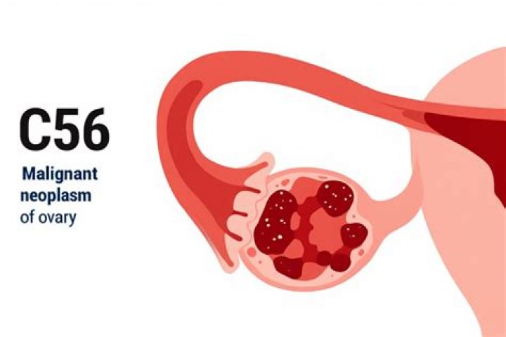 What is malignant neoplasm of unspecified ovary?