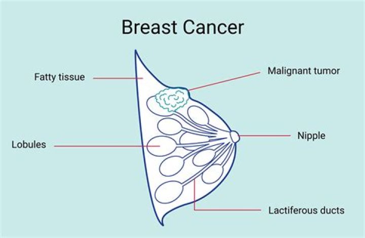What is meant by a mobile breast lump?