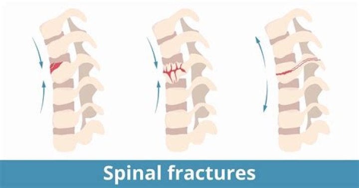 What is Retropulsion of the spine?