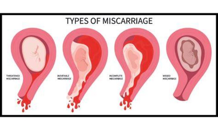What is the difference between miscarriage and missed miscarriage?