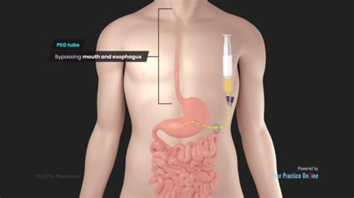 What is the ICD-10 code for placement of gastrostomy tube?